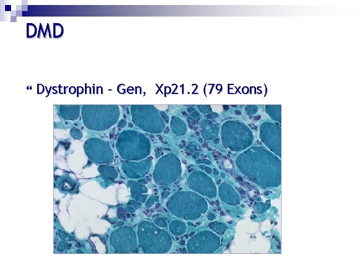 DMD Dystrophin – Gen, Xp 21. 2 (79 Exons) 