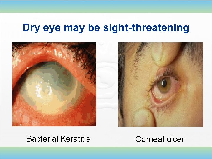 Dry eye may be sight-threatening Bacterial Keratitis Corneal ulcer 