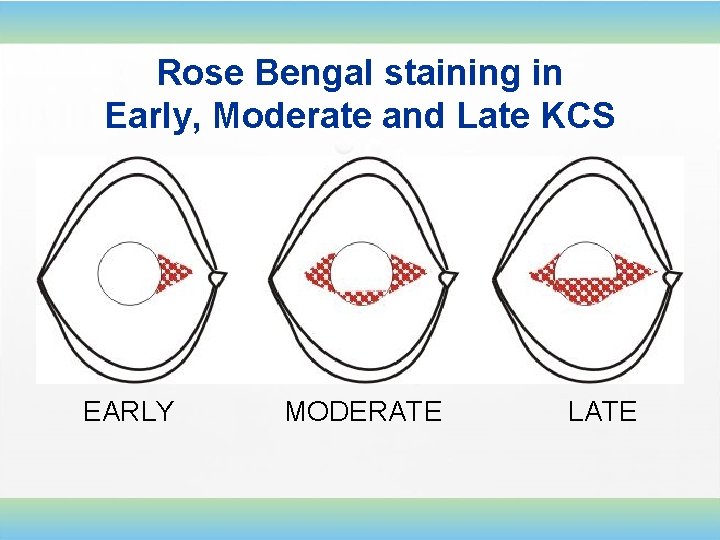 Rose Bengal staining in Early, Moderate and Late KCS EARLY MODERATE LATE 