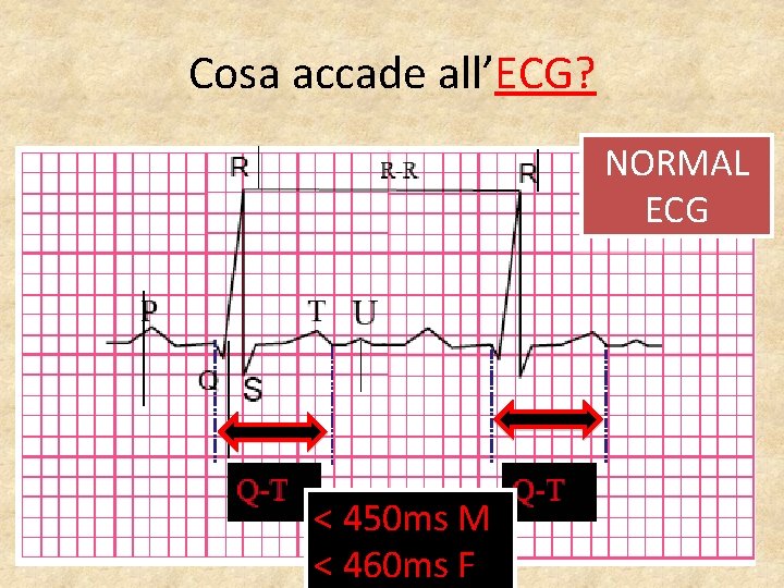 Cosa accade all’ECG? NORMAL ECG < 450 ms M < 460 ms F 