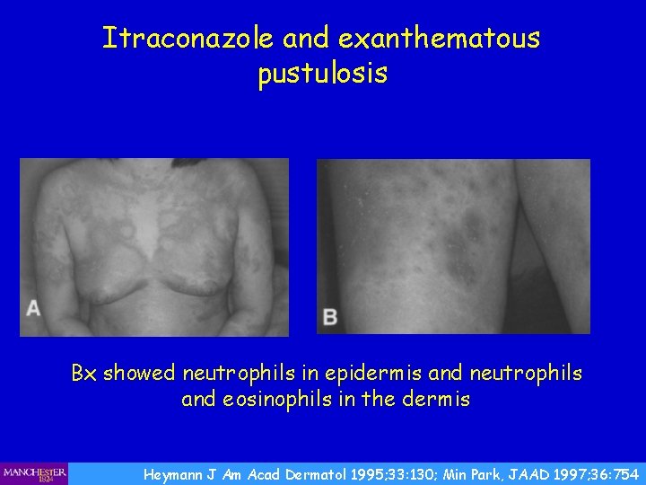 Itraconazole and exanthematous pustulosis Bx showed neutrophils in epidermis and neutrophils and eosinophils in