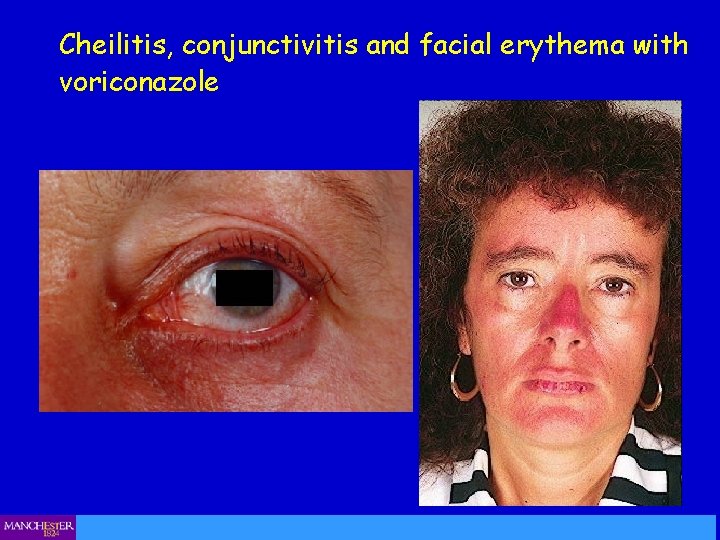 Cheilitis, conjunctivitis and facial erythema with voriconazole 