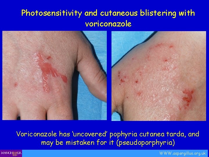 Photosensitivity and cutaneous blistering with voriconazole Voriconazole has ‘uncovered’ pophyria cutanea tarda, and may