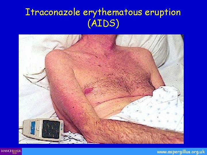 Itraconazole erythematous eruption (AIDS) www. aspergillus. org. uk 