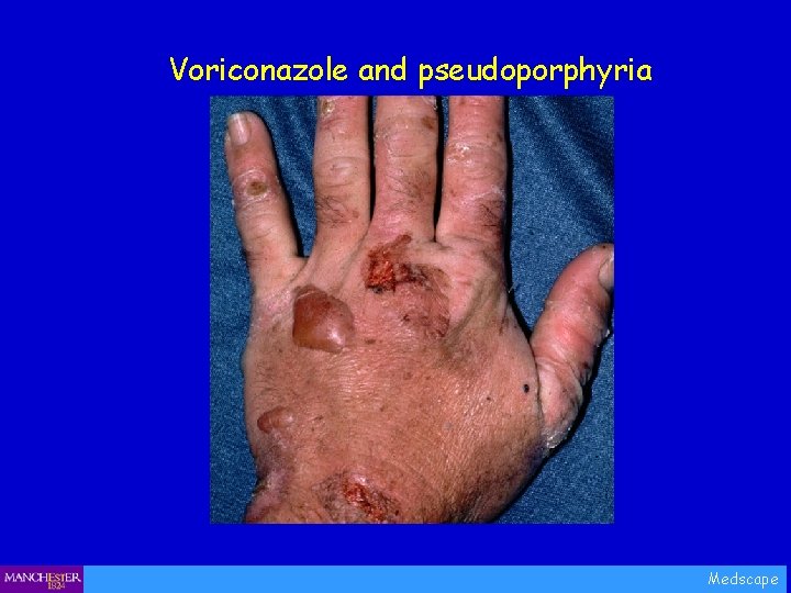 Voriconazole and pseudoporphyria Medscape 