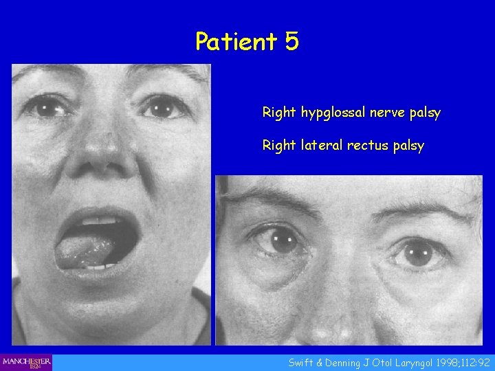 Patient 5 Right hypglossal nerve palsy Right lateral rectus palsy Swift & Denning J