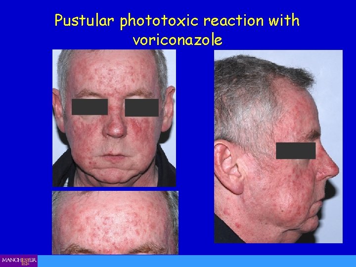 Pustular phototoxic reaction with voriconazole 