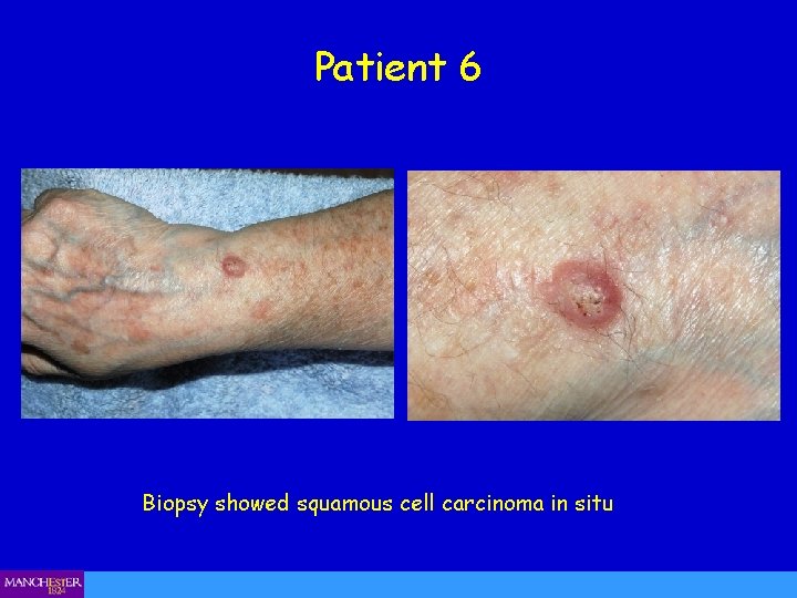 Patient 6 Biopsy showed squamous cell carcinoma in situ 