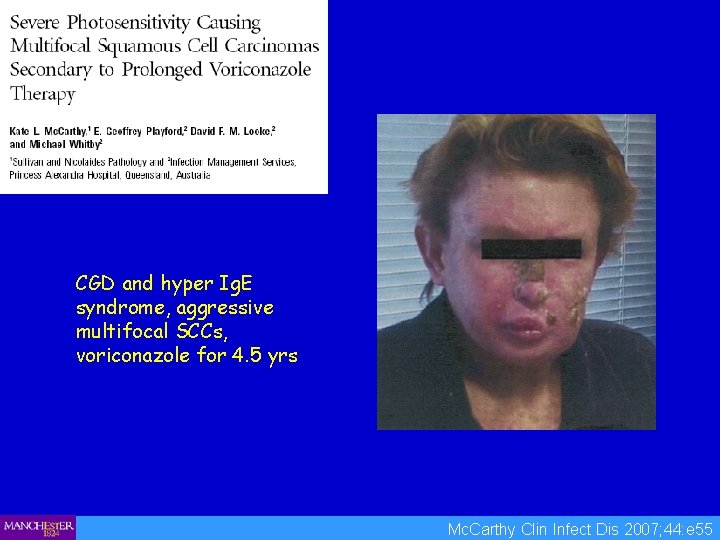 CGD and hyper Ig. E syndrome, aggressive multifocal SCCs, voriconazole for 4. 5 yrs