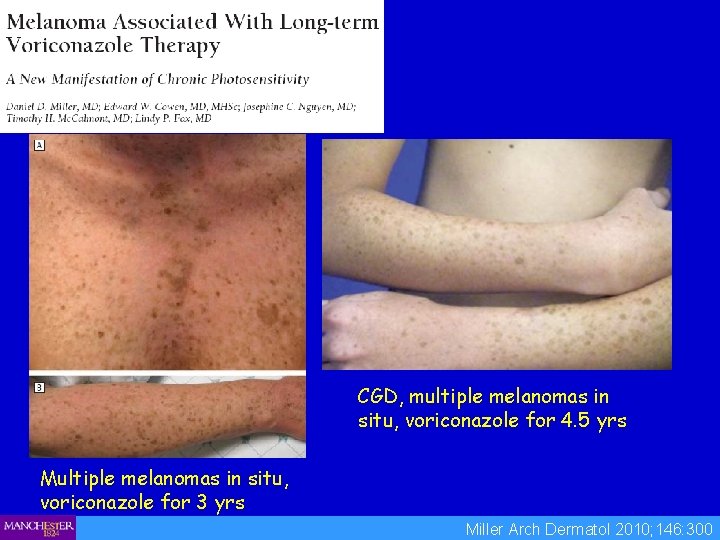 CGD, multiple melanomas in situ, voriconazole for 4. 5 yrs Multiple melanomas in situ,