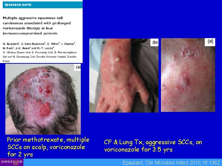 Prior methotrexate, multiple SCCs on scalp, voriconazole for 2 yrs CF & Lung Tx,