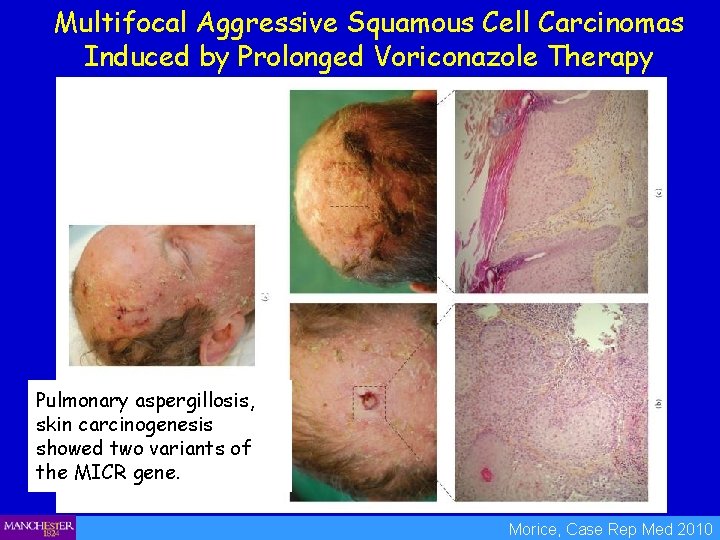Multifocal Aggressive Squamous Cell Carcinomas Induced by Prolonged Voriconazole Therapy Pulmonary aspergillosis, skin carcinogenesis