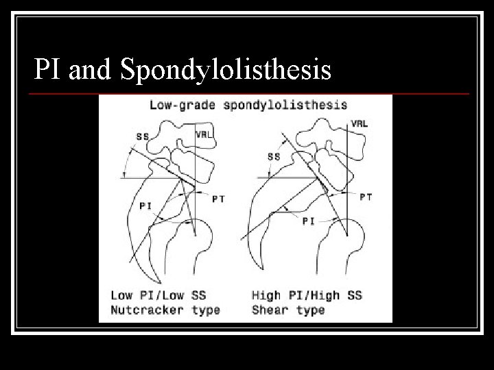 PI and Spondylolisthesis 