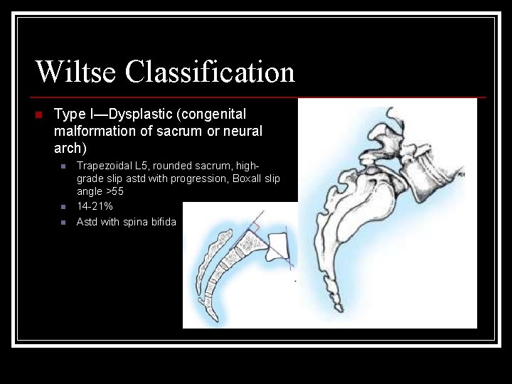 Wiltse Classification n Type I—Dysplastic (congenital malformation of sacrum or neural arch) n n