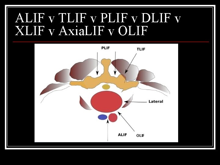 ALIF v TLIF v PLIF v DLIF v XLIF v Axia. LIF v OLIF