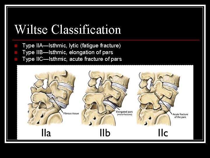 Wiltse Classification n Type IIA—Isthmic, lytic (fatigue fracture) Type IIB—Isthmic, elongation of pars Type