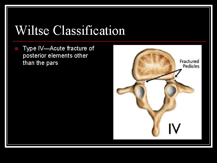 Wiltse Classification n Type IV—Acute fracture of posterior elements other than the pars 