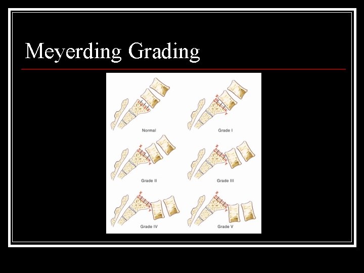 Meyerding Grading 