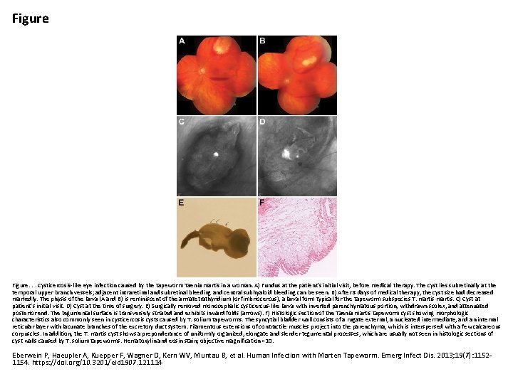 Figure. . . Cysticercosis-like eye infection caused by the tapeworm Taenia martis in a