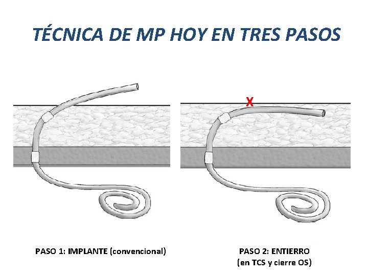 TÉCNICA DE MP HOY EN TRES PASOS X PASO 1: IMPLANTE (convencional) PASO 2: