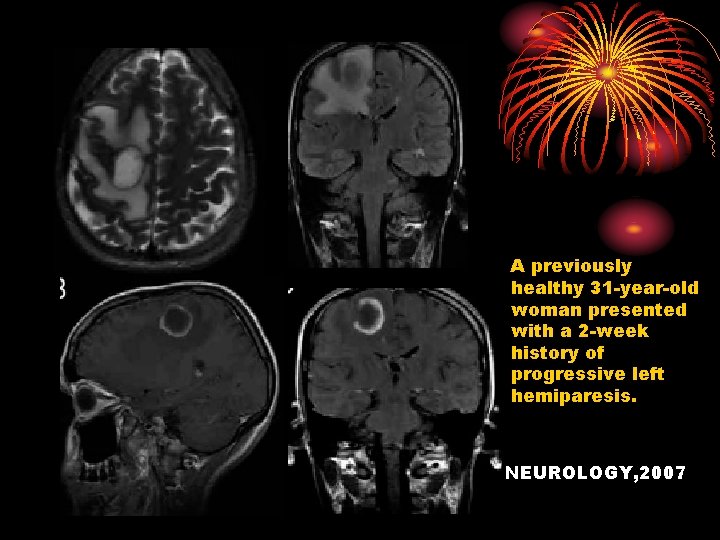 A previously healthy 31 -year-old woman presented with a 2 -week history of progressive