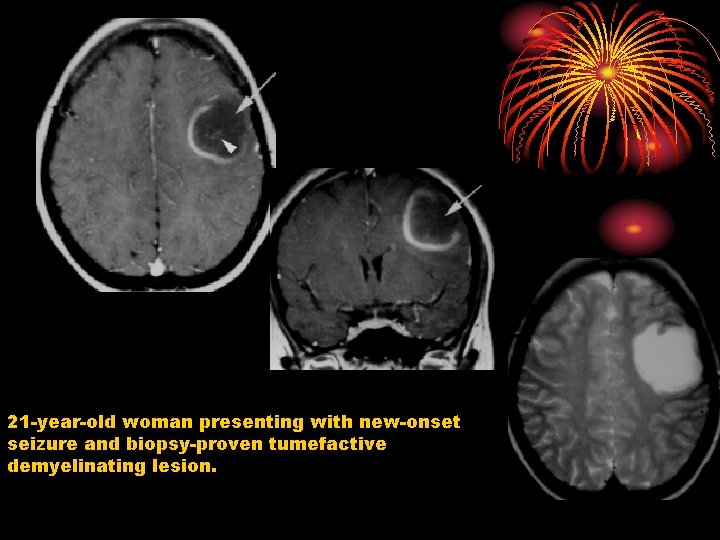 21 -year-old woman presenting with new-onset seizure and biopsy-proven tumefactive demyelinating lesion. 