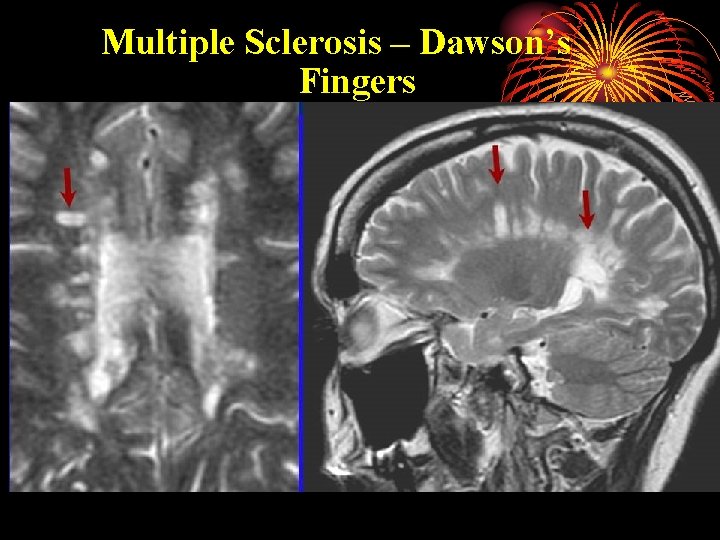 Multiple Sclerosis – Dawson’s Fingers 