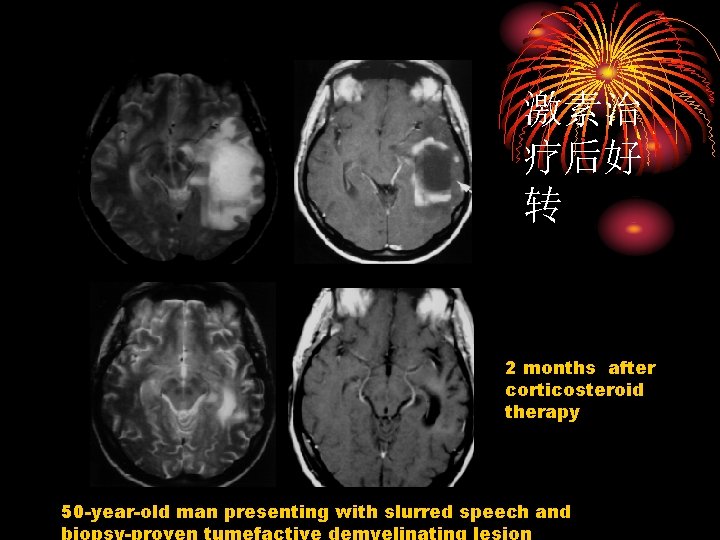 激素治 疗后好 转 2 months after corticosteroid therapy 50 -year-old man presenting with slurred