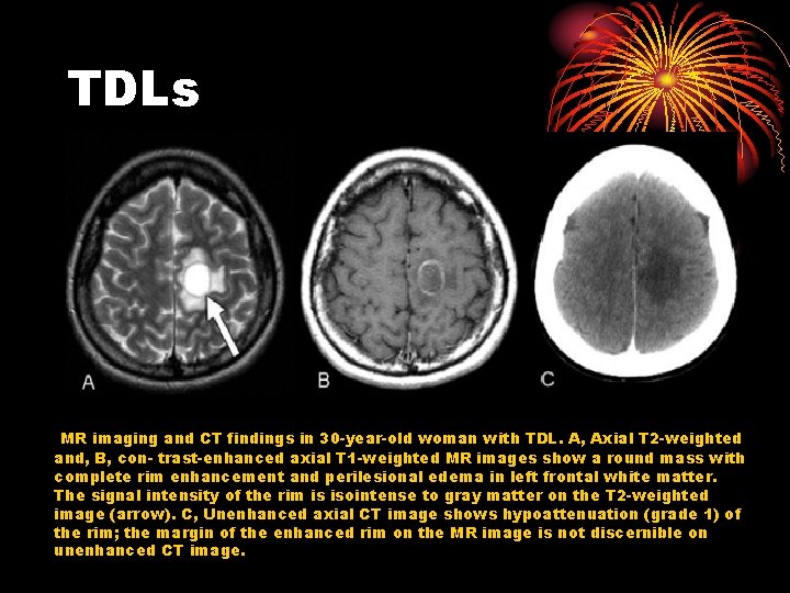 TDLs MR imaging and CT findings in 30 -year-old woman with TDL. A, Axial