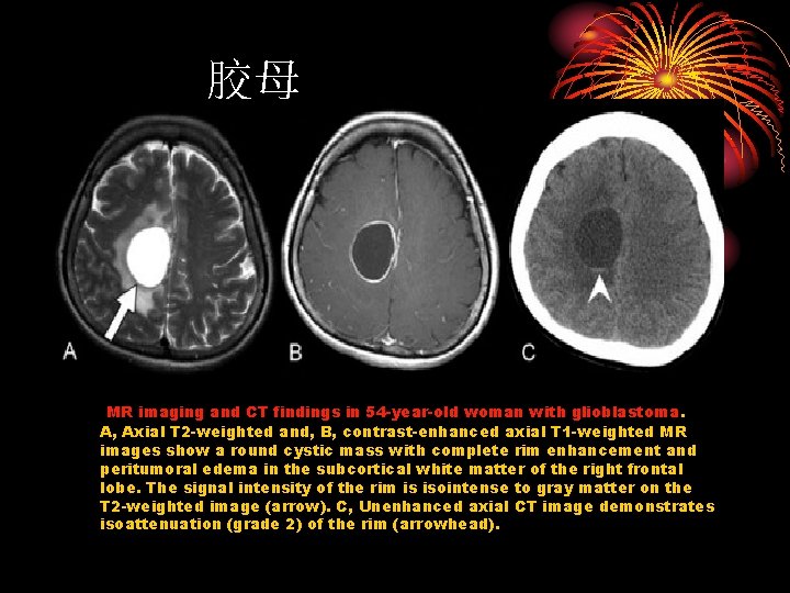 胶母 MR imaging and CT findings in 54 -year-old woman with glioblastoma. A, Axial