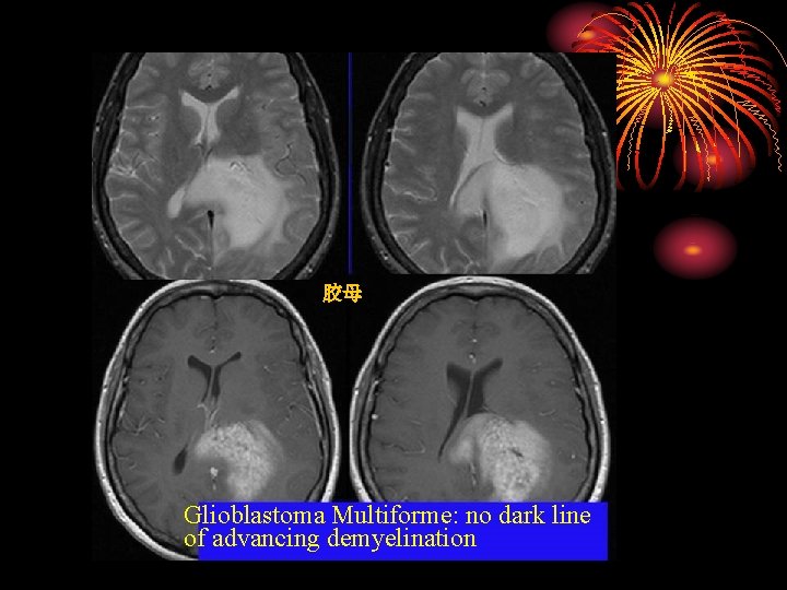 胶母 Glioblastoma Multiforme: no dark line of advancing demyelination 