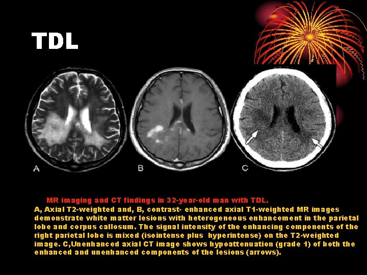 TDL MR imaging and CT findings in 32 -year-old man with TDL. A, Axial