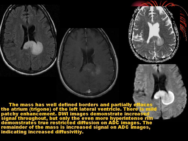 The mass has well defined borders and partially effaces the atrium (trigone) of the