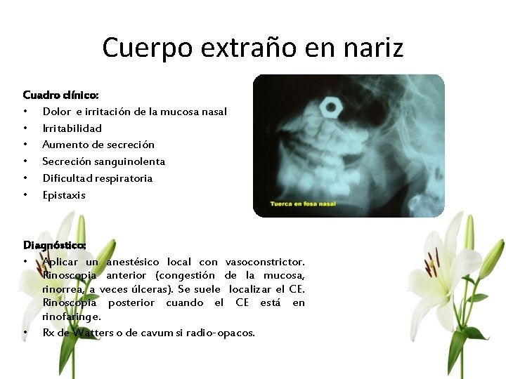 Cuerpo extraño en nariz Cuadro clínico: • Dolor e irritación de la mucosa nasal