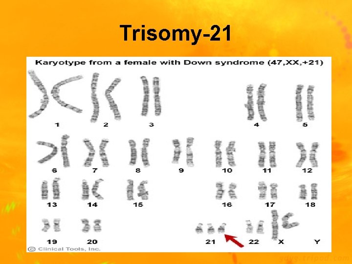 Trisomy-21 