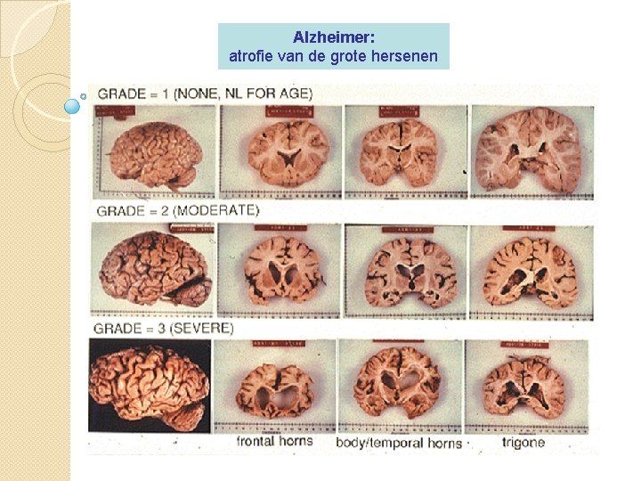 Alzheimer: atrofie van de grote hersenen 