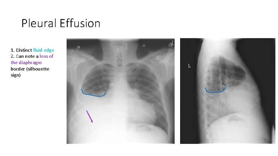 Pleural Effusion 1. Distinct fluid edge 2. Can note a loss of the diaphragm Pleural Effusion 1. Distinct fluid edge 2. Can note a loss of the diaphragm