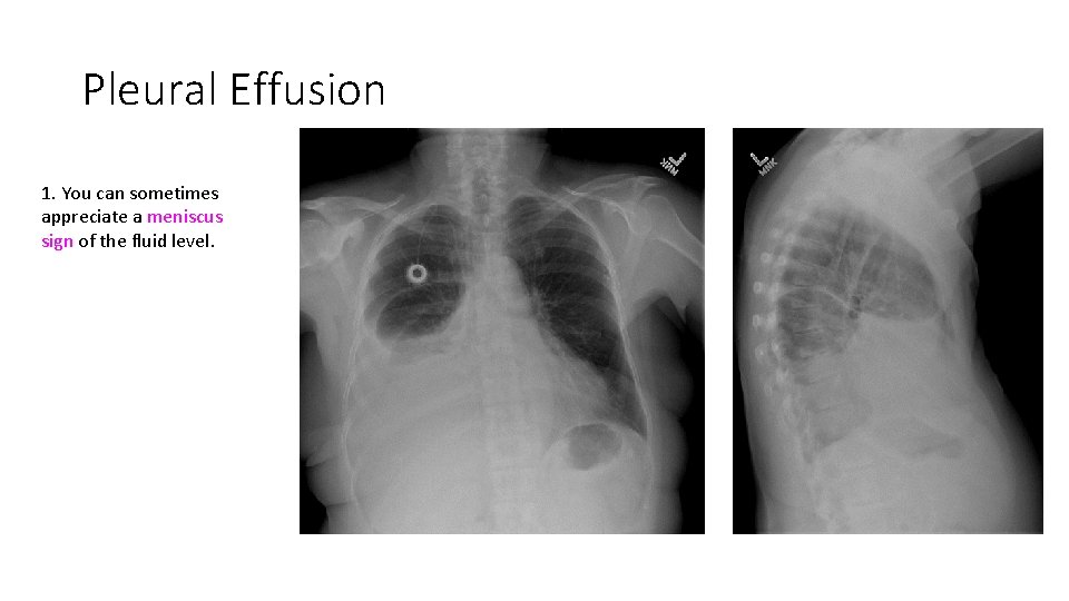 Pleural Effusion 1. You can sometimes appreciate a meniscus sign of the fluid level. Pleural Effusion 1. You can sometimes appreciate a meniscus sign of the fluid level.