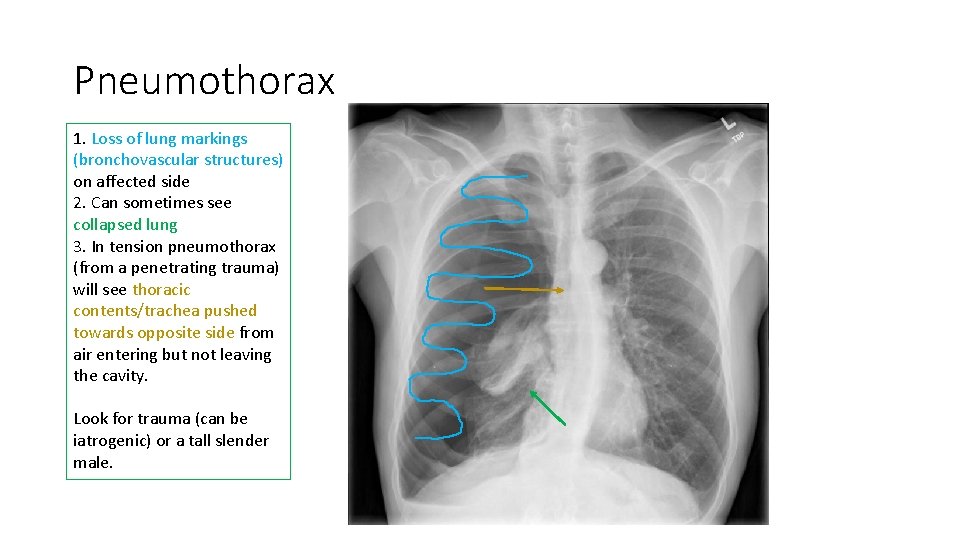 Pneumothorax 1. Loss of lung markings (bronchovascular structures) on affected side 2. Can sometimes Pneumothorax 1. Loss of lung markings (bronchovascular structures) on affected side 2. Can sometimes