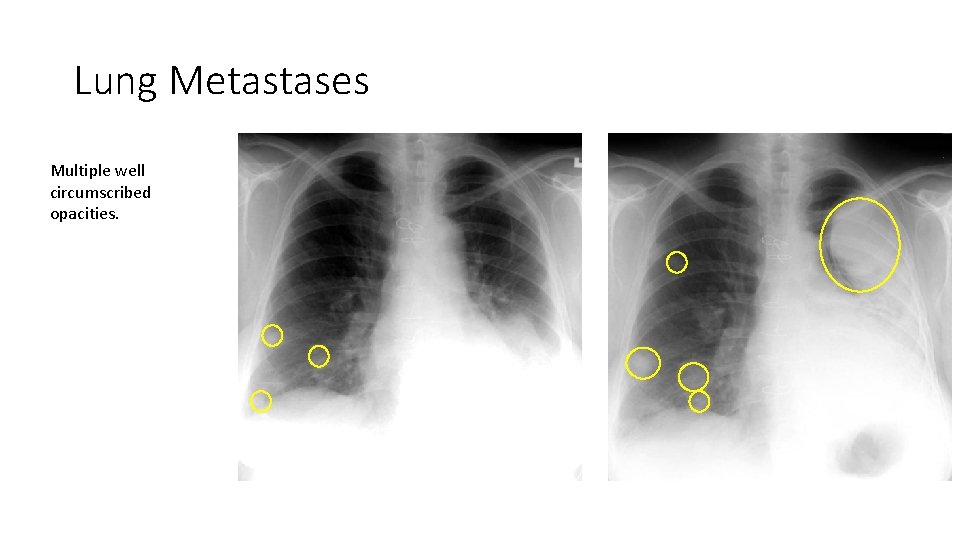 Lung Metastases Multiple well circumscribed opacities. Lung Metastases Multiple well circumscribed opacities.