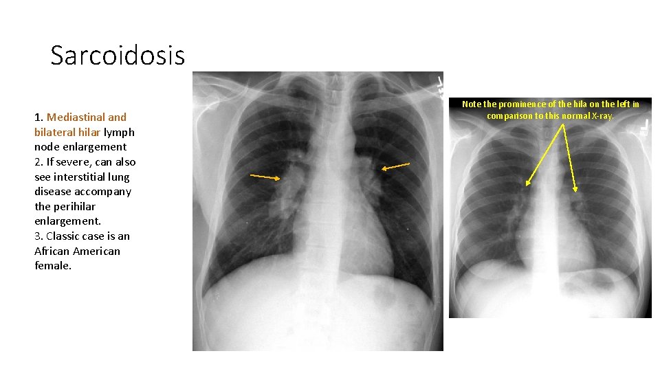 Sarcoidosis 1. Mediastinal and bilateral hilar lymph node enlargement 2. If severe, can also Sarcoidosis 1. Mediastinal and bilateral hilar lymph node enlargement 2. If severe, can also