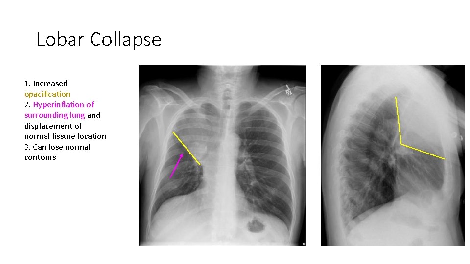 Lobar Collapse 1. Increased opacification 2. Hyperinflation of surrounding lung and displacement of normal Lobar Collapse 1. Increased opacification 2. Hyperinflation of surrounding lung and displacement of normal