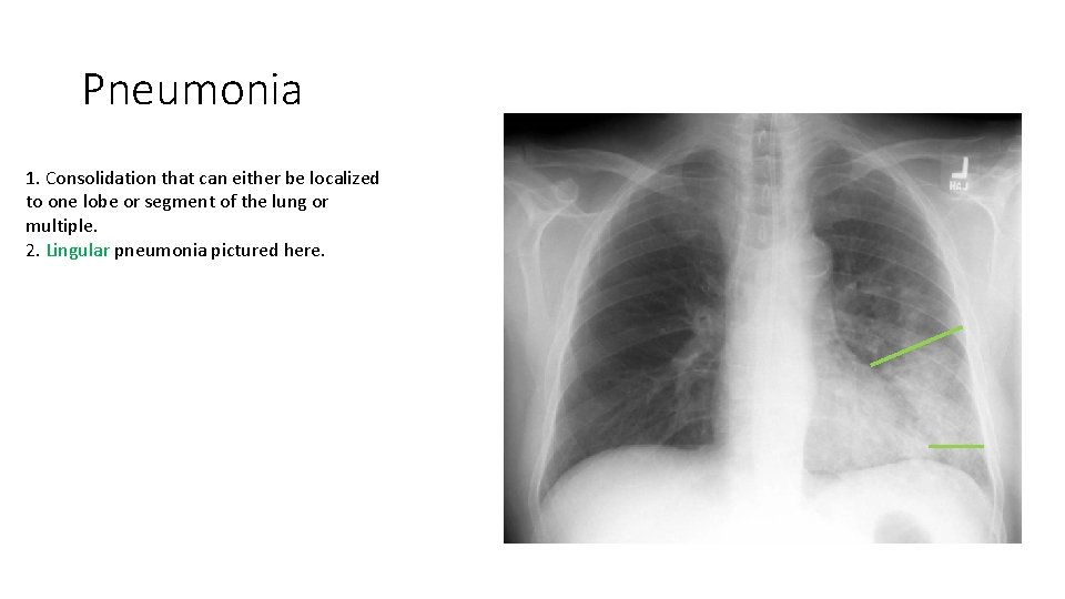 Pneumonia 1. Consolidation that can either be localized to one lobe or segment of Pneumonia 1. Consolidation that can either be localized to one lobe or segment of