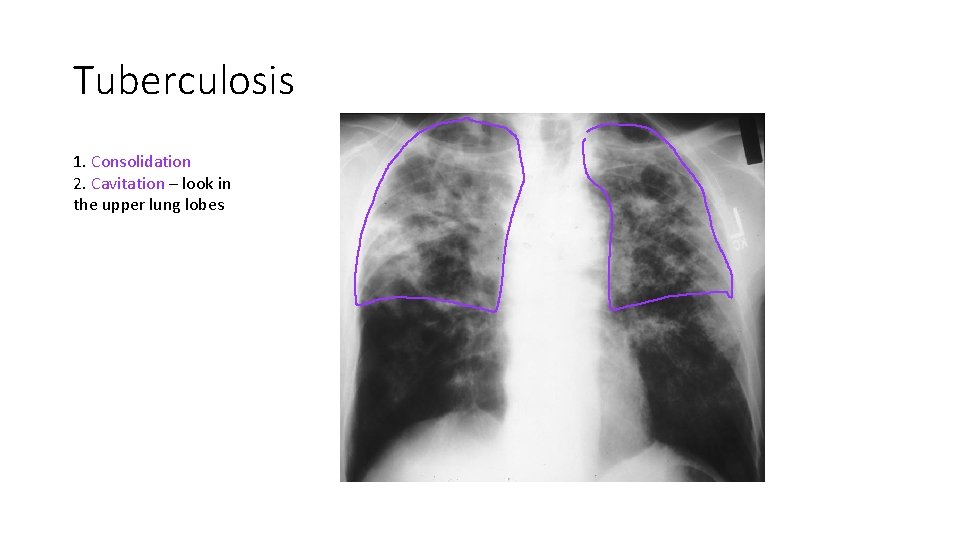 Tuberculosis 1. Consolidation 2. Cavitation – look in the upper lung lobes Tuberculosis 1. Consolidation 2. Cavitation – look in the upper lung lobes