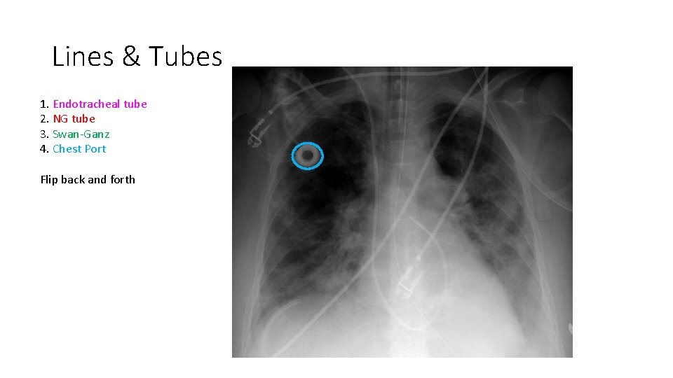 Lines & Tubes 1. Endotracheal tube 2. NG tube 3. Swan-Ganz 4. Chest Port Lines & Tubes 1. Endotracheal tube 2. NG tube 3. Swan-Ganz 4. Chest Port