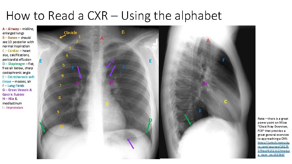 How to Read a CXR – Using the alphabet A – Airway – midline, How to Read a CXR – Using the alphabet A – Airway – midline,