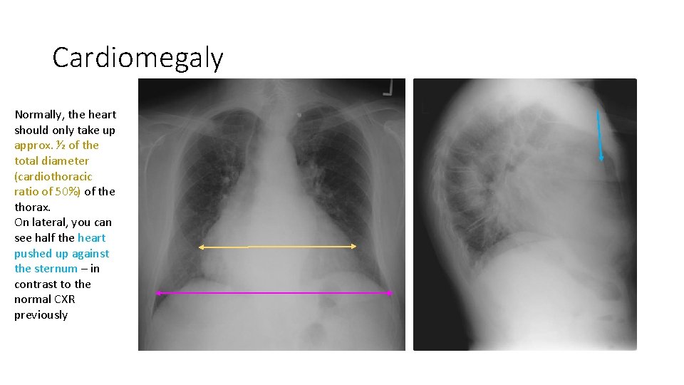 Cardiomegaly Normally, the heart should only take up approx. ½ of the total diameter Cardiomegaly Normally, the heart should only take up approx. ½ of the total diameter