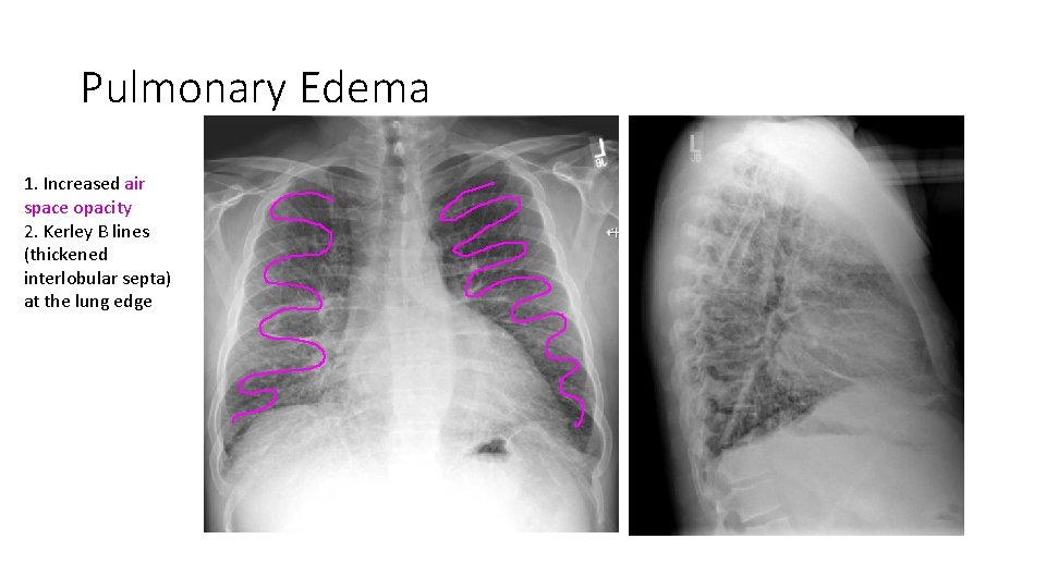Pulmonary Edema 1. Increased air space opacity 2. Kerley B lines (thickened interlobular septa) Pulmonary Edema 1. Increased air space opacity 2. Kerley B lines (thickened interlobular septa)