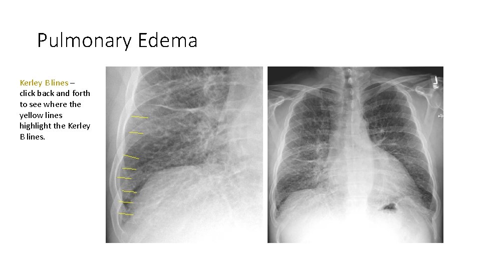 Pulmonary Edema Kerley B lines – click back and forth to see where the Pulmonary Edema Kerley B lines – click back and forth to see where the