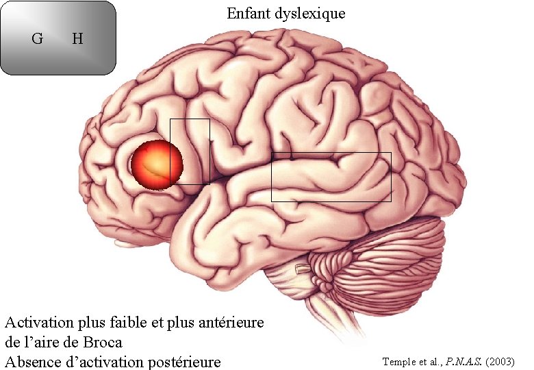 Enfant dyslexique G H Activation plus faible et plus antérieure de l’aire de Broca